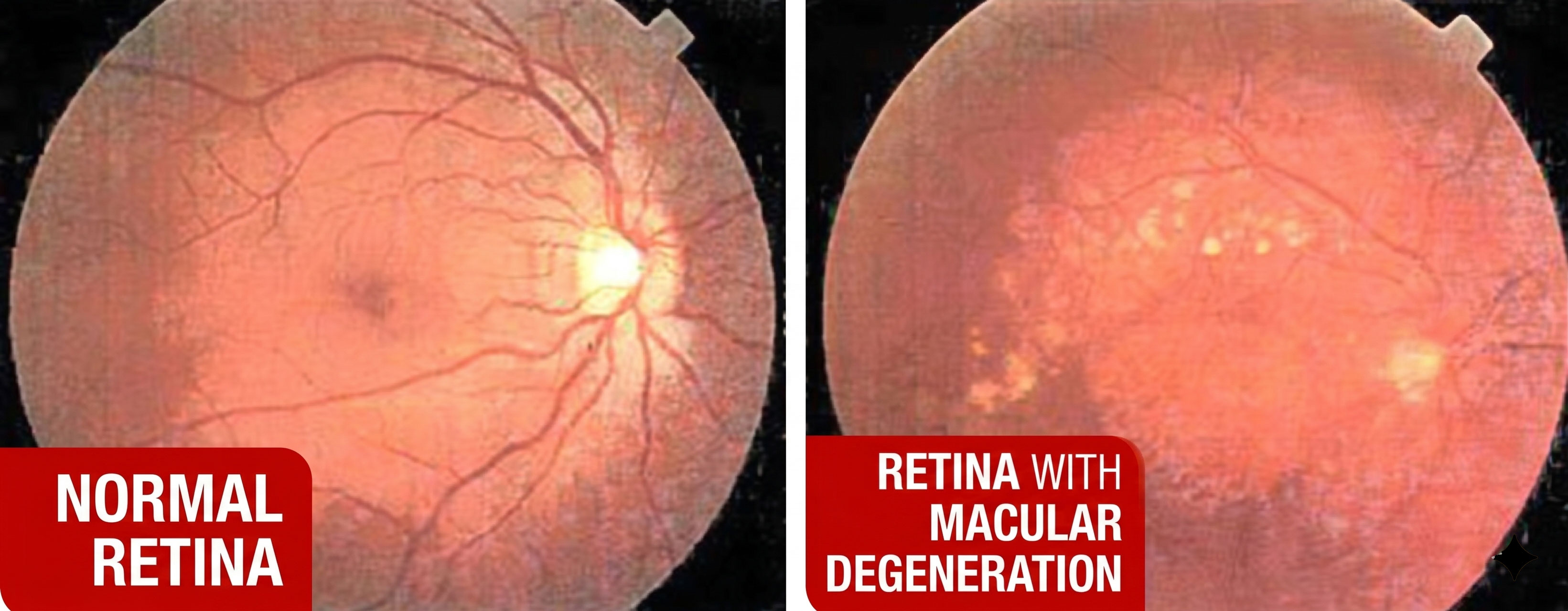 retina